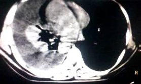 CT Chest Pain